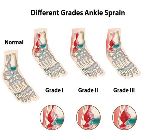 How To Heal A Sprained Ankle Fast At Home Sporty Doctor