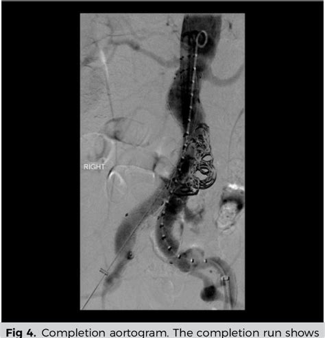 Figure 2 From A Simplified Method Of Pre Emptive Perigraft Aortic Sac