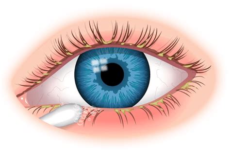 Blepharitis Asia Retina Singapore