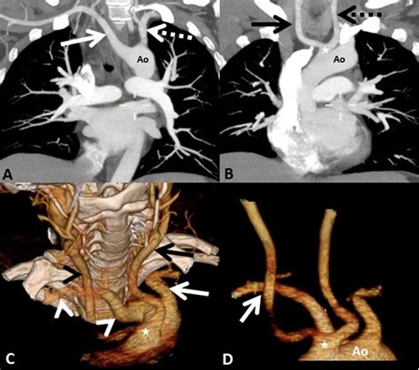 CT Angiography Of The Chest And Neck A Oblique Image Showing The ARSA