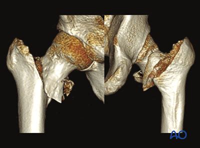 Simple pertrochanteric fractures with posteromedial involvement