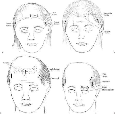 Endoscopic Forehead Lifting Plastic Surgery Key