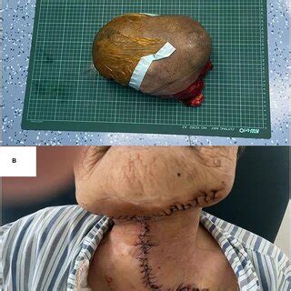 Gross View Of The Resected Specimen A And Appearance Of The Incision