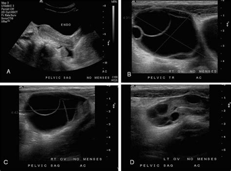 Pelvic Ultrasound Obtained During Initial Admission A Sagittal Image