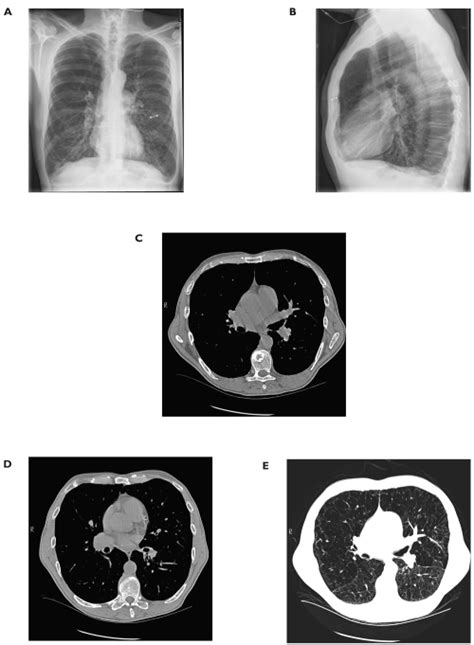 A Posterior Anterior Chest X Ray And B Lateral Chest X Ray