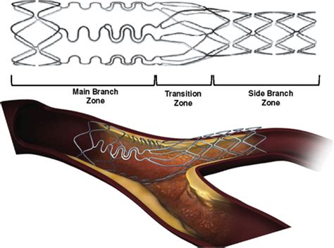 Dedicated Bifurcation Stent For The Treatment Of Bifurcation Lesions