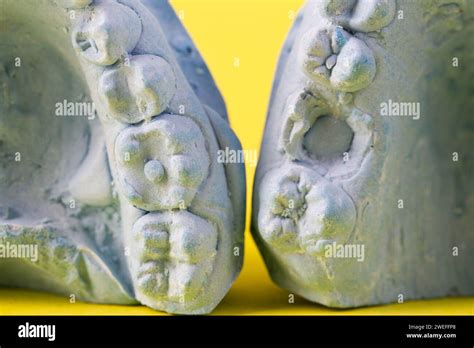 Blue Plaster Impression Of A Patient S Dental Jaw With Crooked Teeth