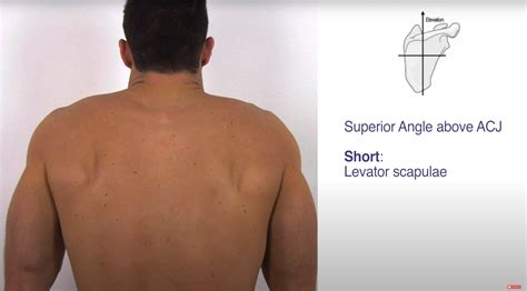 Scapular Alignment Scapular Dyskinesis Assessment