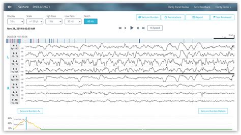 Ceribell Rapid Response EEG With AI For Seizure Detection