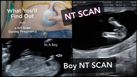 Gender Scan Diagnostic Ultrasound Services Pregnancy Scans Atelier