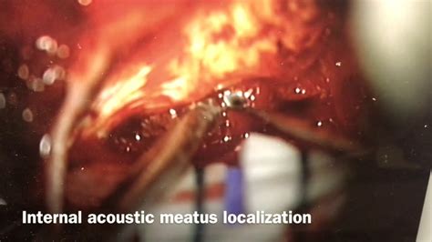 Retrosigmoid Approach For Vestibular Schwannoma Vestibular Schwanoma