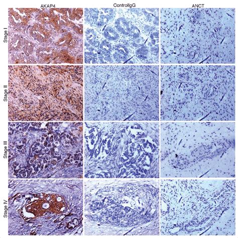 Akap Expression In Representative Stage I Stage Ii Stage Iii And