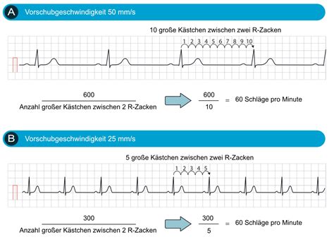 Der Sinusrhythmus Physiologie Ekg Kriterien Und Klinische Bedeutung