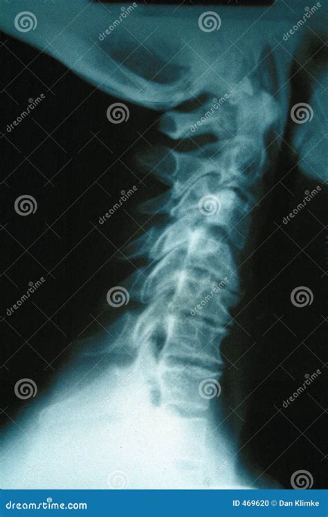 Closeup Xray Of Human Neck Stock Photo - Image: 469620