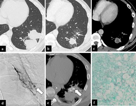 A 51 Year Old Man With A Pulmonary Arterial Pseudoaneurysm Pap Due Download Scientific