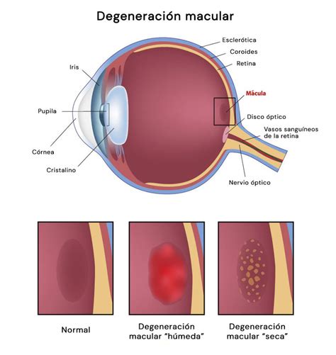 Qué es la degeneración macular Lenstore es