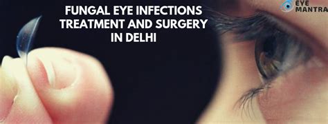 Fungal Eye Infection:Types, Symptoms, treatment & surgery| eyemantra