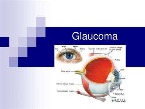 Ppt Glaucoma Powerpoint Presentation Free Download Id5096621