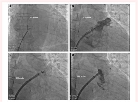 A Fluoroscopic Illustration Of The Intracardiac Echocardiography