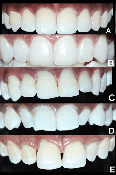 Management Of Stained Fluorotic Teeth By Combined Minimal Invasive