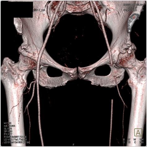 Acute Arterial Occlusion