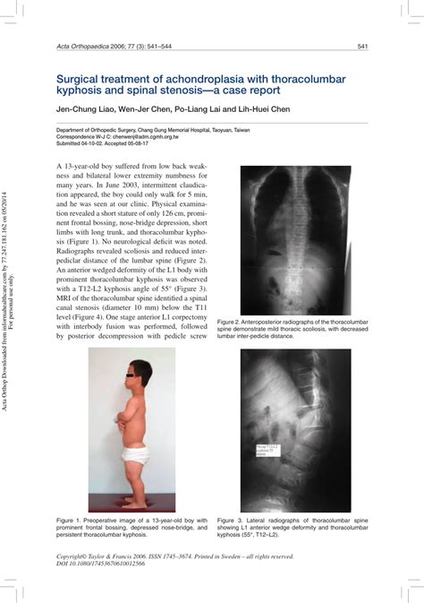 (PDF) Surgical treatment of achondroplasia with thoracolumbar kyphosis ...