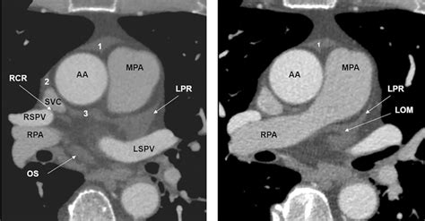 20 The Pericardium Radiology Key