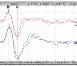 Vestibular Testing Accura Audiology PLLC