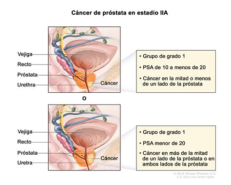 Tratamiento Del C Ncer De Pr Stata Nci