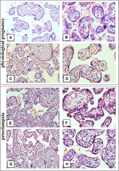 Histological Examination Of Placental Villous Trees In Preeclampsia And