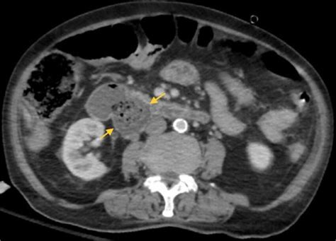 Duodenal Diverticular Bezoar Axial Ct Image With Iv Contrast