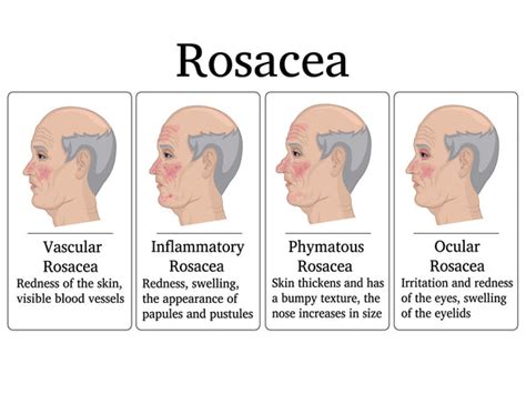 What Are The 4 Types Of Rosacea Balmonds