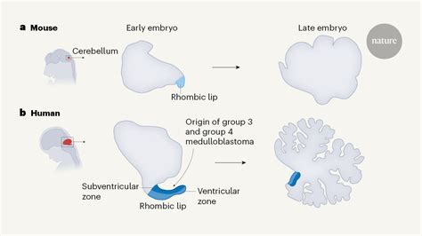 The origins of medulloblastoma tumours in humans