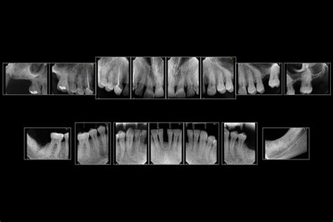 Radiografía Periapical Total INARAD