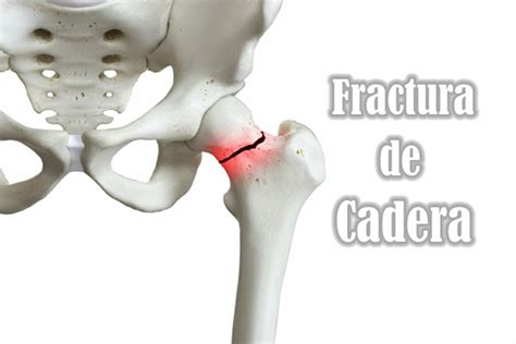 Fractura De Cadera Clinica Hispana Harrisburg