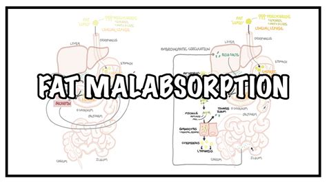 Approach to Fat malabsorption - signs and symptoms and causes - Gerber Ambulance News - General ...