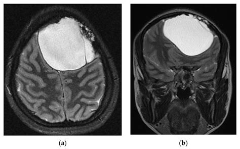 Brain Sciences Free Full Text Intraoperative Rupture Of An