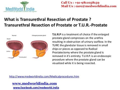 Minimally Invasive Laser Prostate Turp Surgery In India