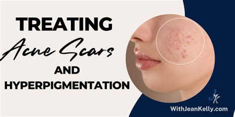 A Guide To Treating Acne Scars And Hyperpigmentation Jean Kelly Acne