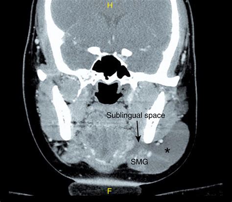 Surgical Management Of Ranula Clinical Tree