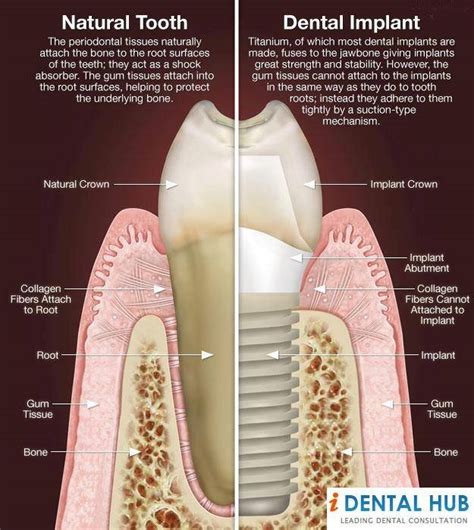 Dental Implant Why It Is The Most Advanced Tooth Replacement Option