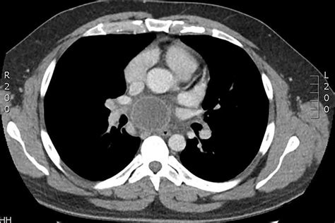 Axial CT scan demonstrating ring enhancing subcarinal mass. | Download ...