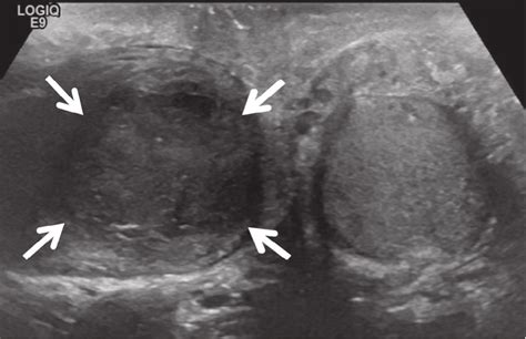 Grayscale B Mode Ultrasound Transverse Section Transverse B Mode