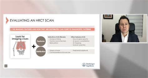 Hrct Vs X Ray For Ild Evaluation Suspect Ild