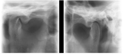 Diagnostyka stawów skroniowo żuchwowych SSŻ w Pracowni 3D tomografia