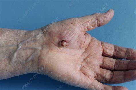 Granuloma Annulare On Hands