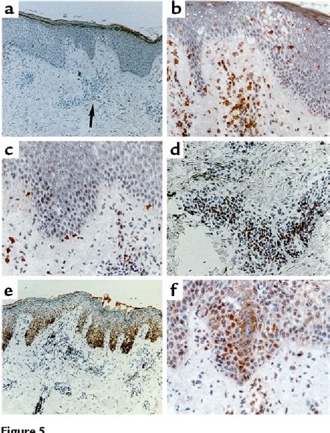 Figure From T Cell Mediated Fas Induced Keratinocyte Apoptosis Plays