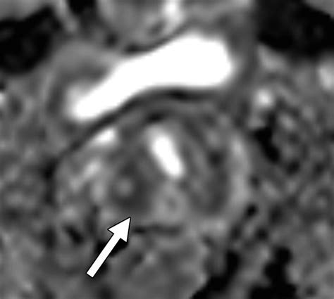 Anterior Prostate Cancer Diagnostic Performance Of T2 Weighted MRI And