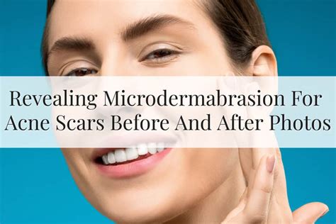 New Microdermabrasion For Acne Scars Before And After (2023)