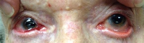 Interesting eye cases: Unusual conjunctival edema with dilated blood ...